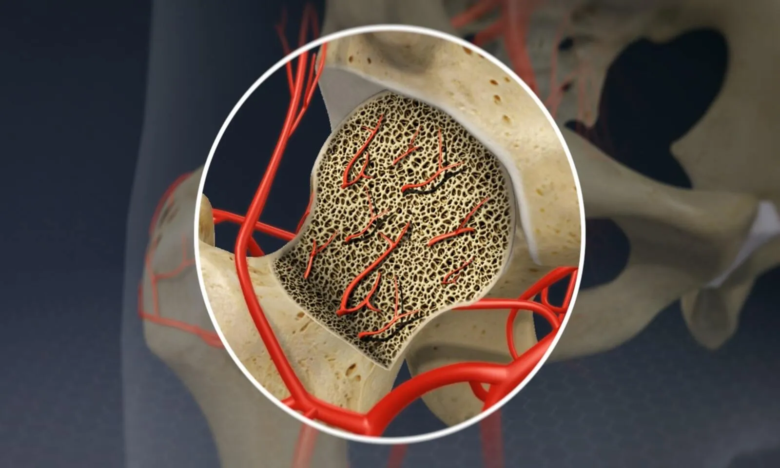 Explained: What is Avascular Necrosis, the latest post-COVID condition