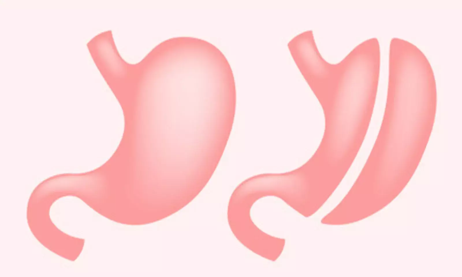 Explained: How Non-invasive Weight Loss Surgery Helps Control Diabetes Explained: How Non-invasive Weight Loss Surgery Helps Control Diabetes