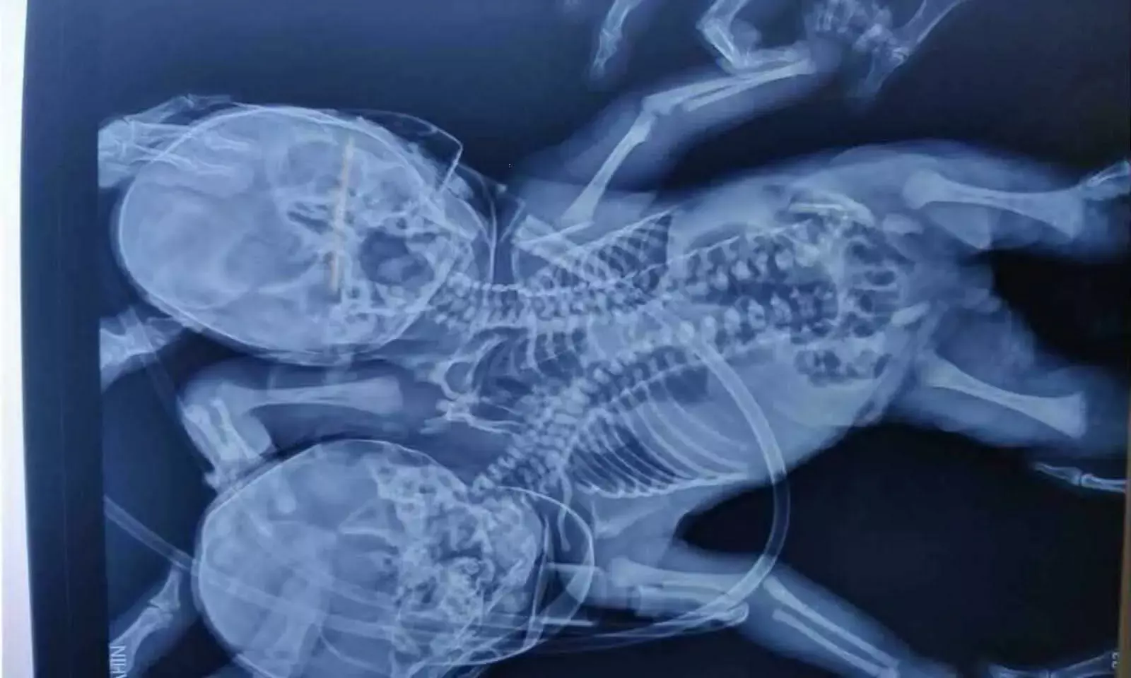 Explained: The Rare Condition Twins Born with One Torso Suffer From Explained: The Rare Condition Twins Born with One Torso Suffer From