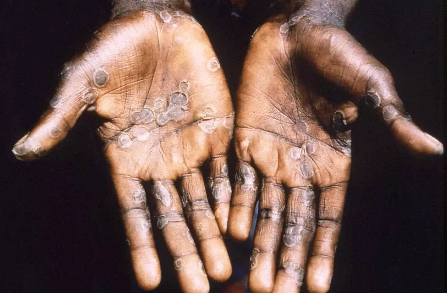 Monkeypox Outbreak in Europe: All You Need to Know About the Viral Disease Monkeypox Outbreak in Europe: All You Need to Know About the Viral Disease