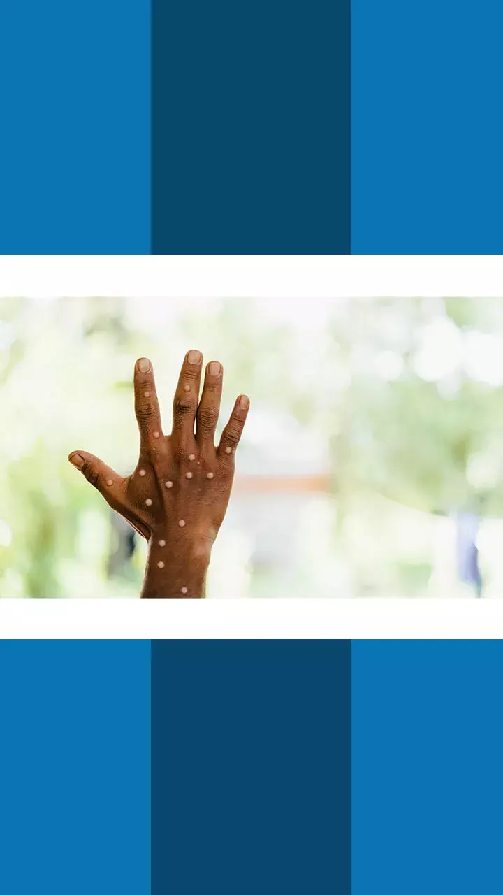 Monkeypox: 5 Myths Around the Virus Debunked