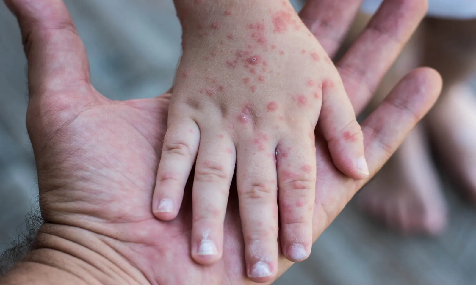 Tomato Fever: All You Need to Know About the New Viral Illness in India Tomato Fever: All You Need to Know About the New Viral Illness in India
